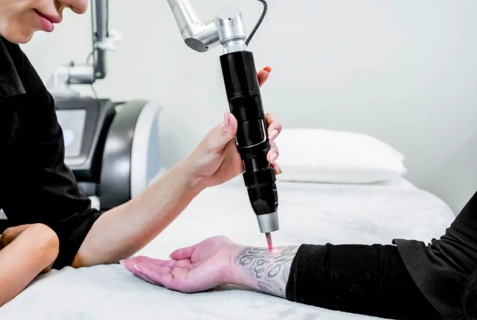 Best Lasers for Tattoo Removal